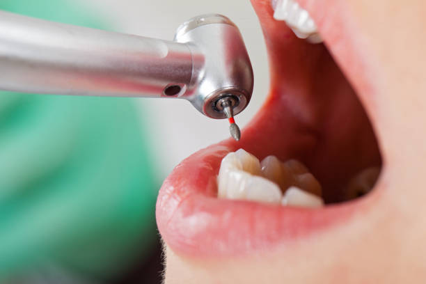 Best Emergency Root Canal Treatment in Salem, IN